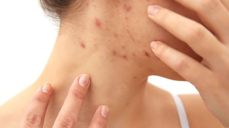 Piknik Sonrası Kaşıntı Paniği: Uyuz Değil Alerjik Reaksiyon Çıktı